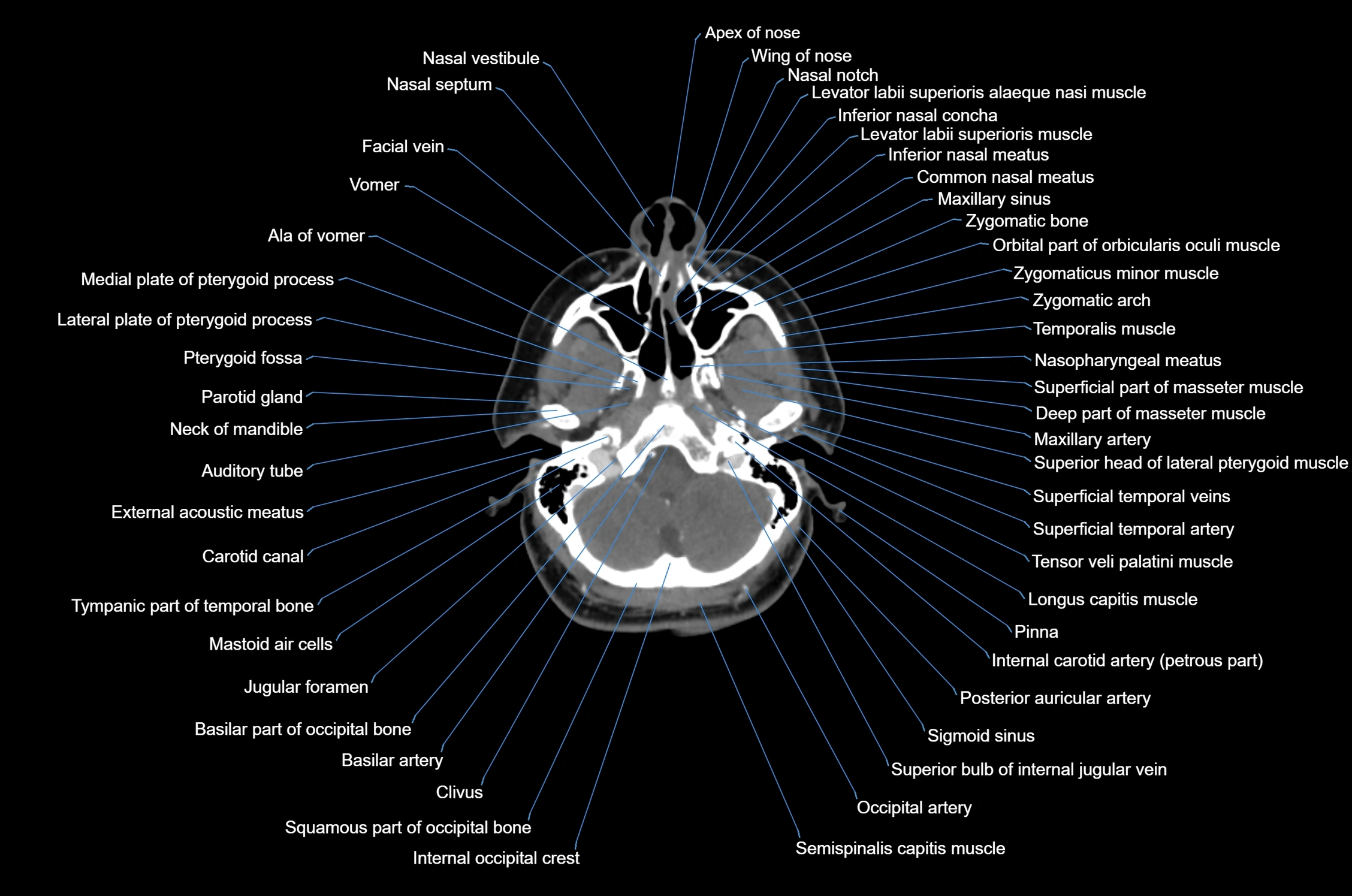 CT Neck axial cross sectional anatomy radiology image-img-00001-00016.webp